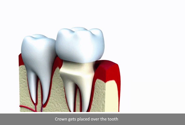dental-crown-Tustin