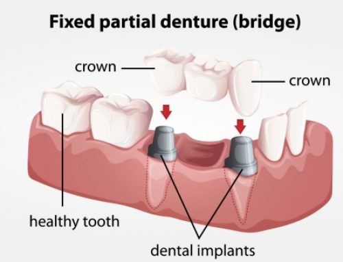 Care for Your Dental Bridges